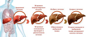 Разрушение печени при гепатите Б